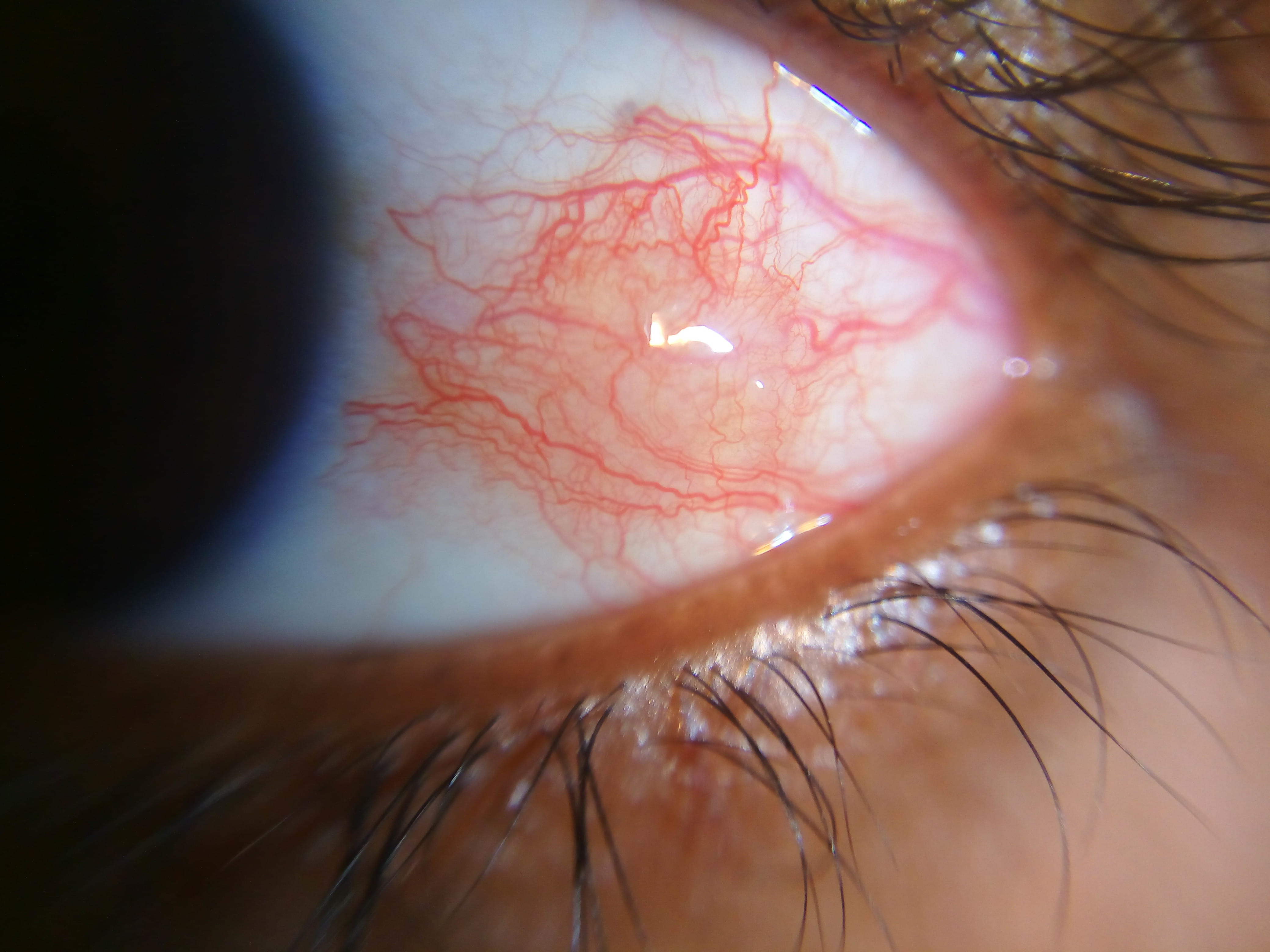 episcleritis.jpg